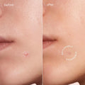 Invisible Pimple & Acne Patches 2