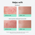 Redness Soothing Azelaic Acid Serum 5