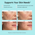 Azelaic Acid Cream for Sensitive Skin 3