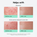 Redness Soothing Azelaic Acid Serum 5